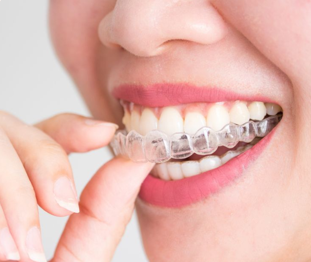Clear Aligners